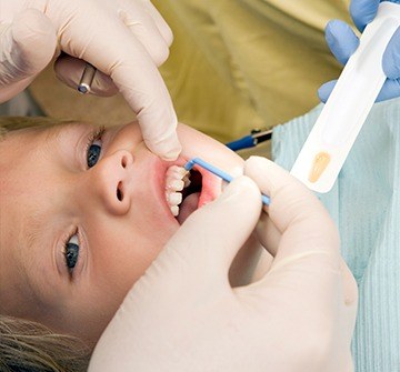 Child receiving fluoride treatment