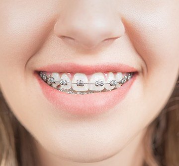 Closeup of smile with braces