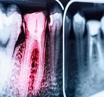 X-ray of root canal treated tooth