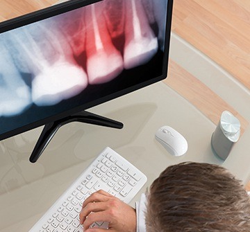 X-rays of root canal treated tooth on computer screen